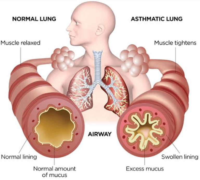 Man practicing deep breathing exercises to manage bronchial asthma symptoms, supported by homeopathic treatment